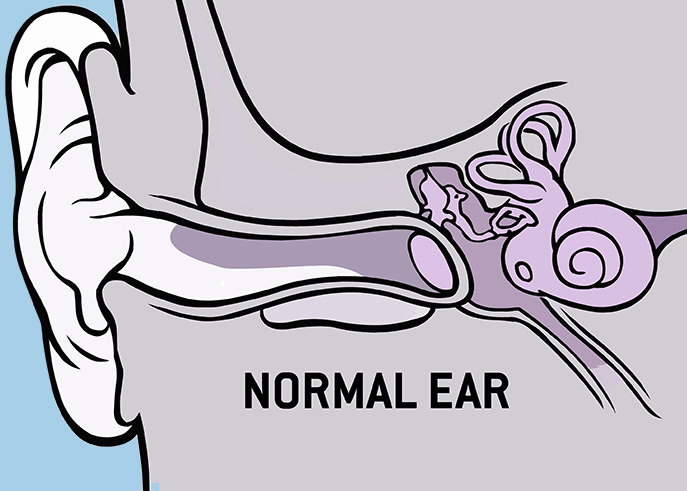 Cholesteatoma Diagram for Normal Ear