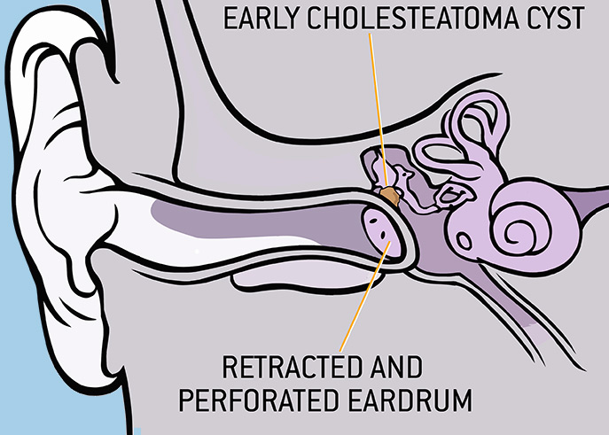 Early Cholesteatoma Cyst Diagram