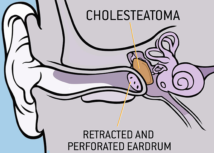 Cholesteatoma Diagram